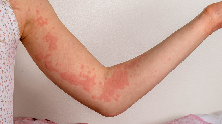 Closeup of woman's arm with hives