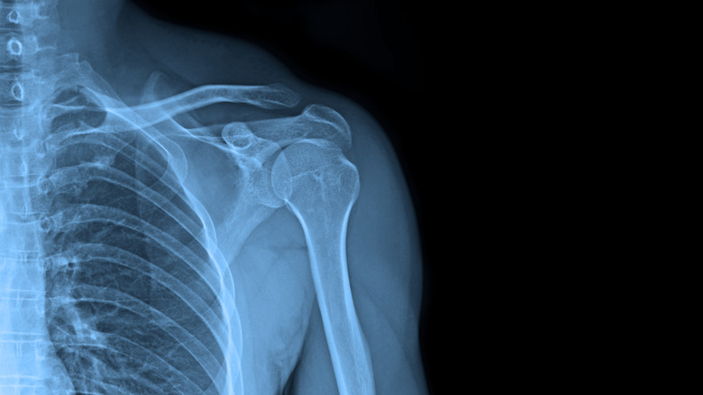 x-ray of shoulder