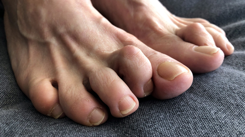 person with hammer toes