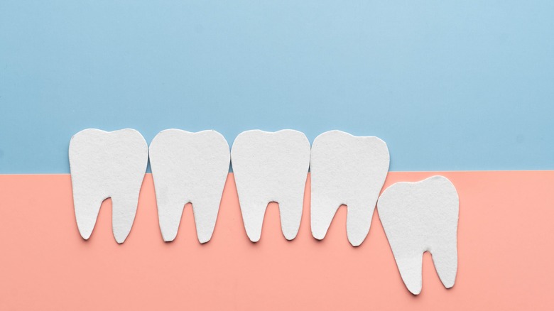 model of impacted tooth