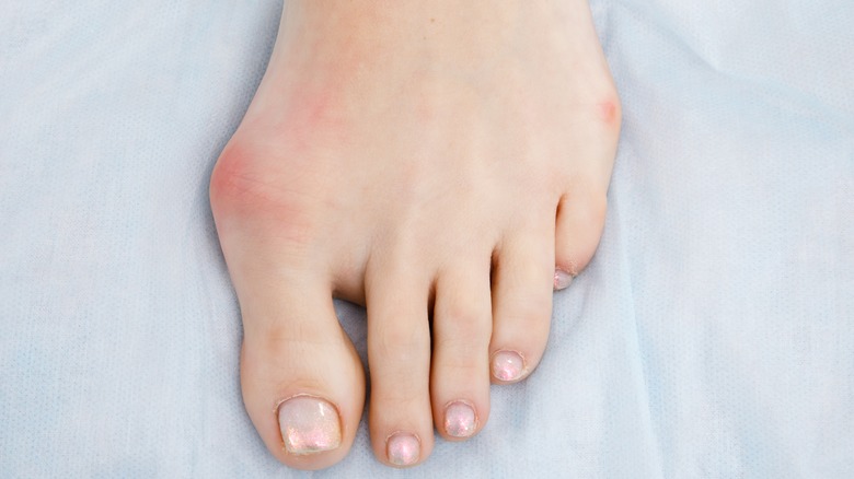 bunion in woman's foot