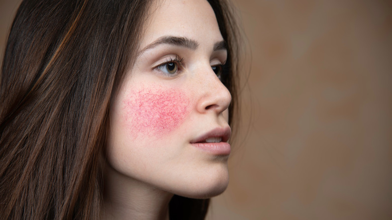 Woman with rosacea on cheeks