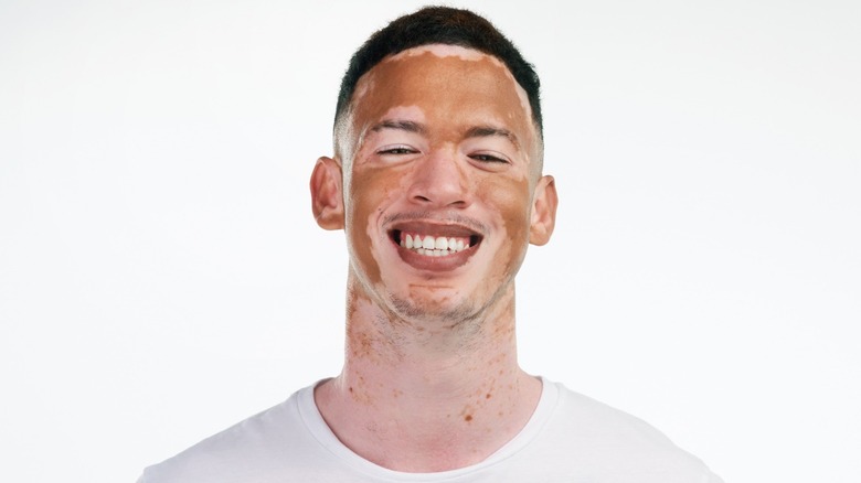 man with vitiligo