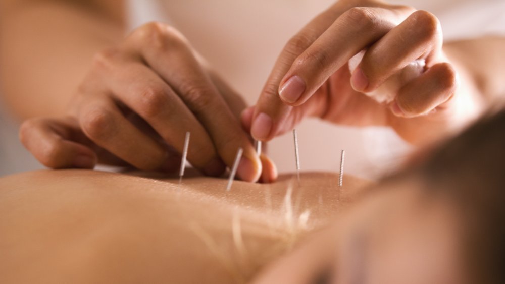Woman receiving acupuncture on her back