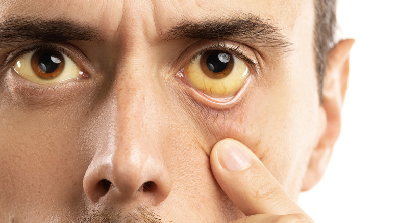 A man with jaundiced eyes
