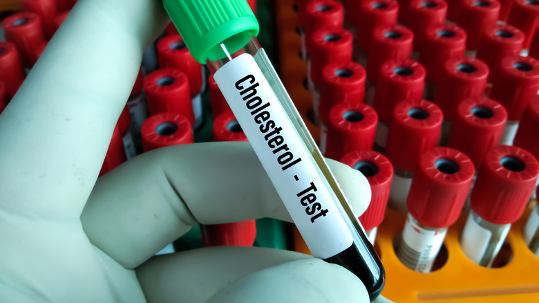 woman holding a test tube for a cholesterol lab work up