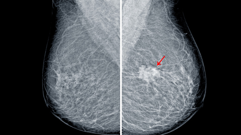 Mammogram X-ray