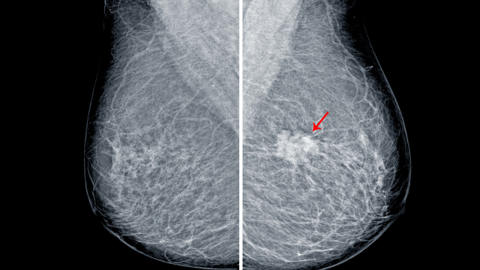 Mammographic microcalcifications and risk of breast cancer