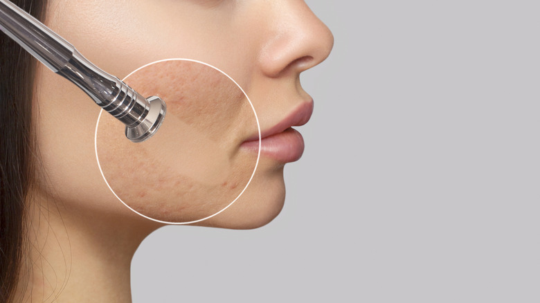 woman with acne getting dermal fillers