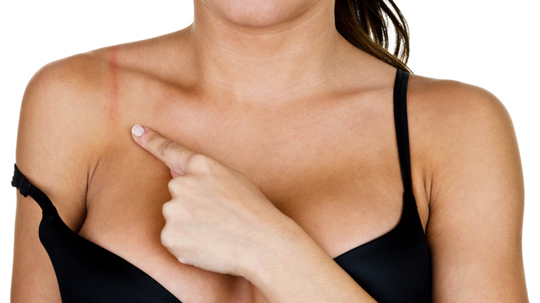 Individual with shoulder indent from bra