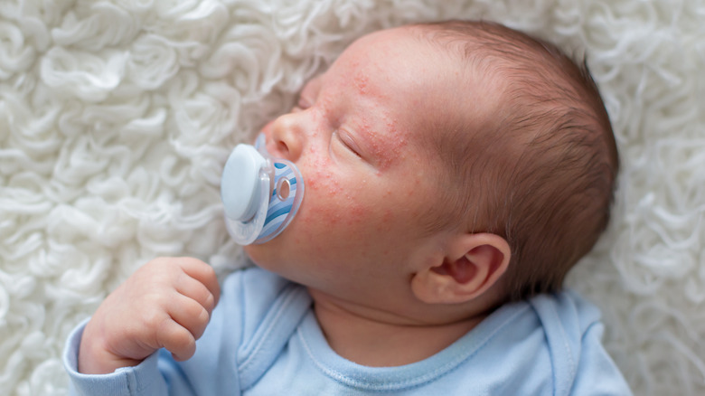 Baby with rash on their face