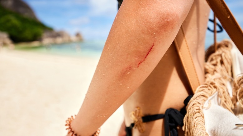 A woman on the beach with a bloody gash on her arm