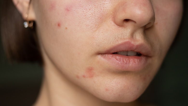 Woman with hormonal acne