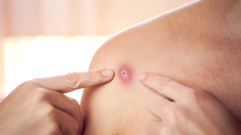a swollen boil on a person's shoulder 