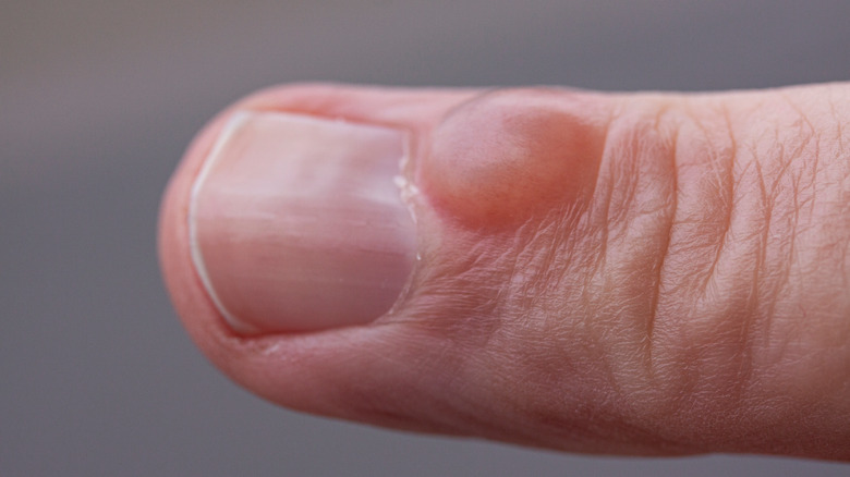 Small cyst on a person's finger