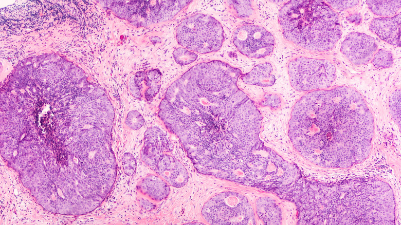 ductal carcinoma image
