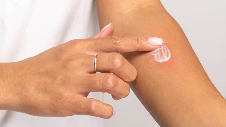 woman applying cream to a bug bite