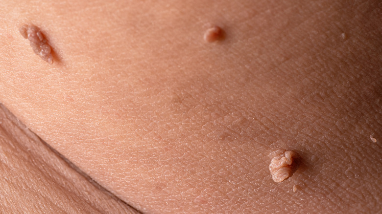 skin tag on body