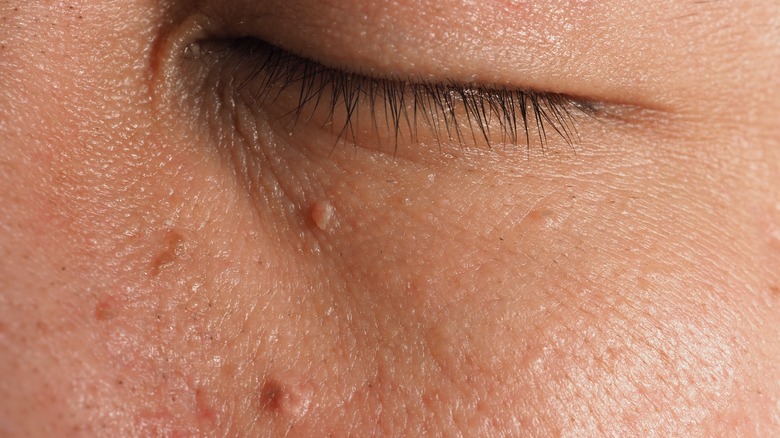 skin tag on face