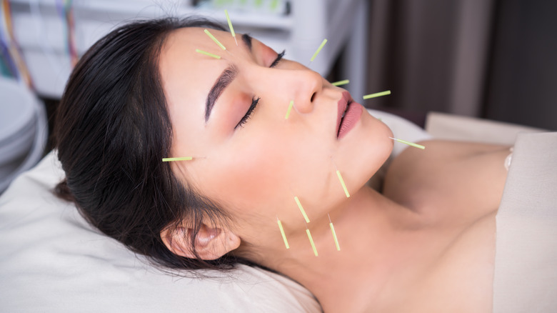 Young woman undergoing acupuncture treatment on face