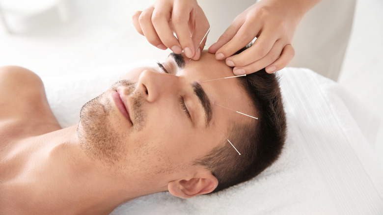 Young man undergoing acupuncture treatment 
