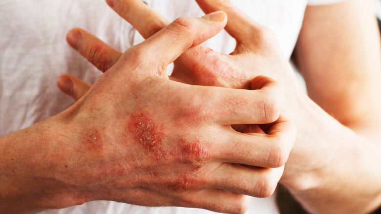 Hands itching plaque psoriasis