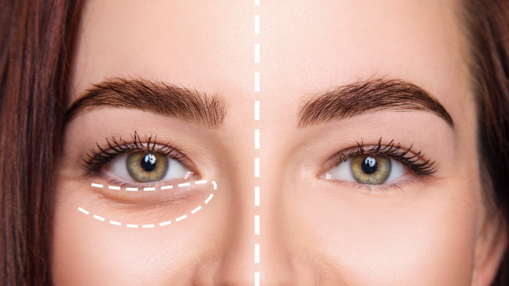 Under eye bags