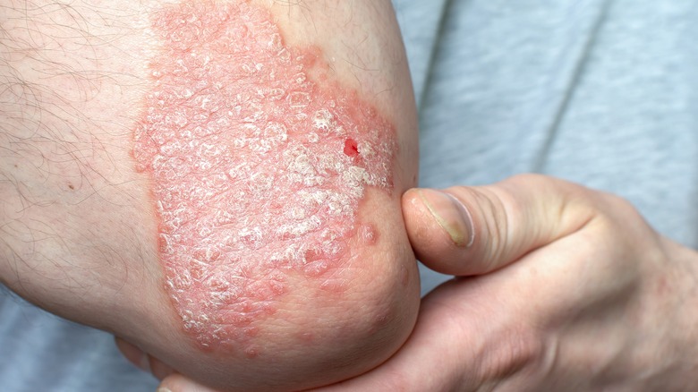 Psoriasis on an elbow