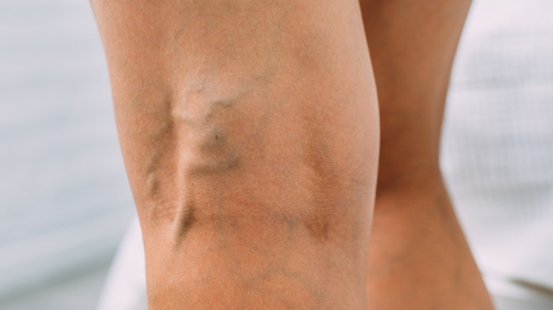 Varicose veins on legs