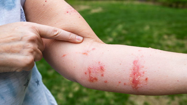 Close up of poison ivy rash on arm