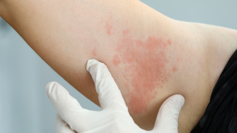 A band of shingles around a person's arm