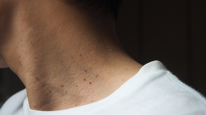 Several skin tags on neck