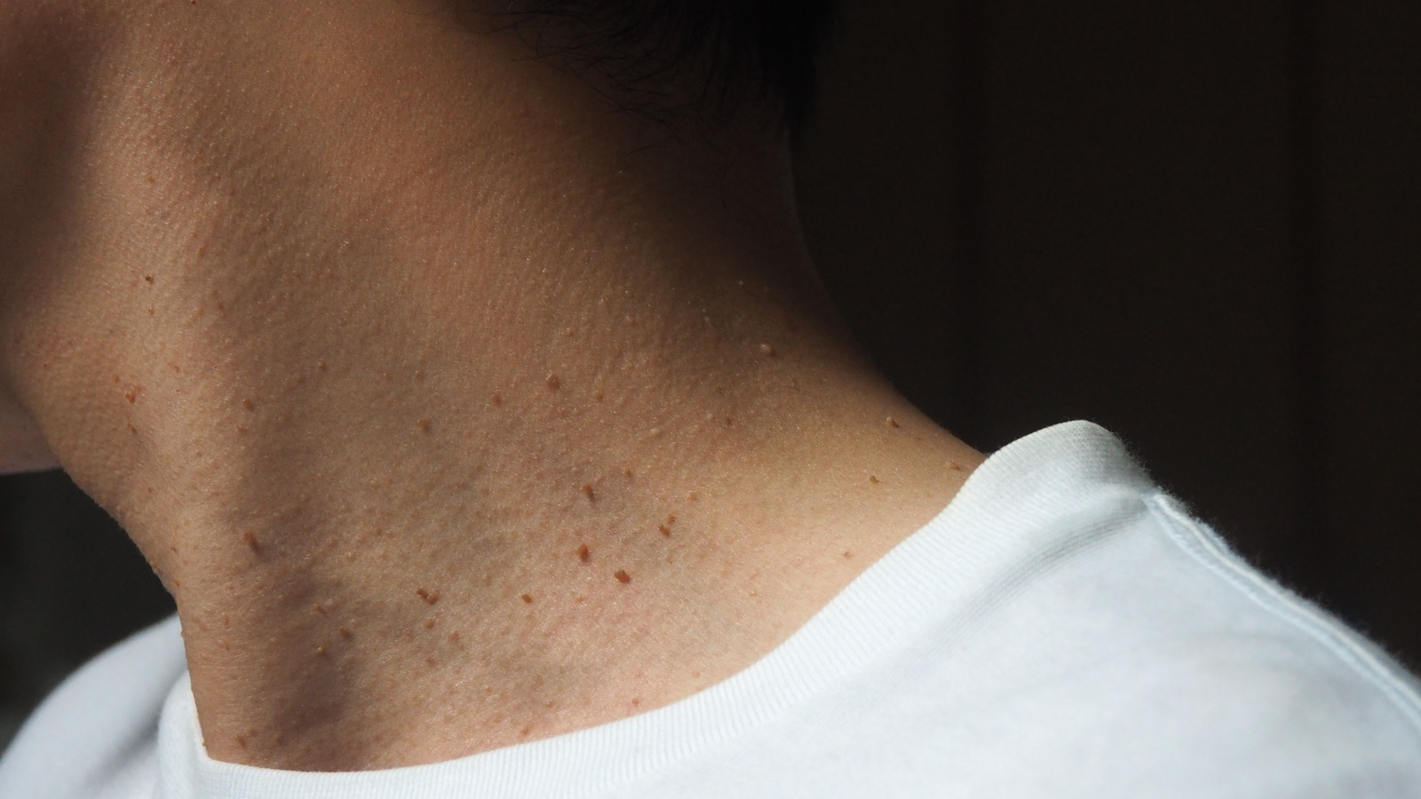Can Skin Tags Be Cancerous 