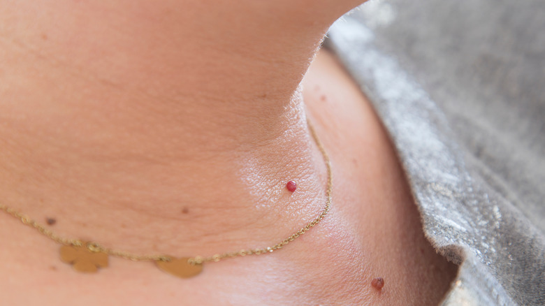 Skin tag on neck