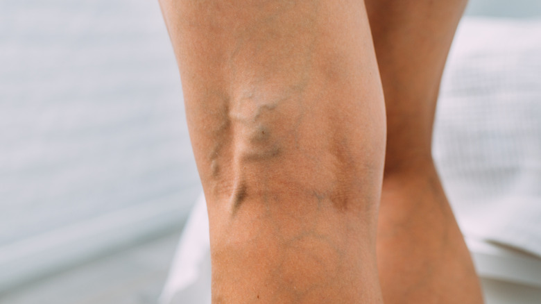 Close up on varicose veins on legs