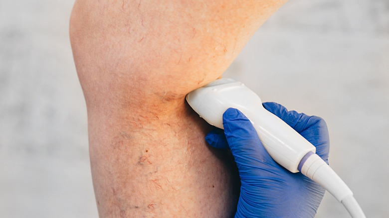 Leg receiving vein treatment by doctor