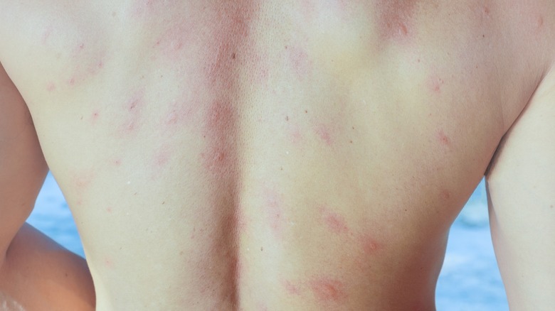 seabather's eruption ocean allergy 