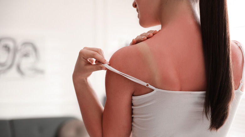 back view of a woman showing a sunburn on her shoulders and back 