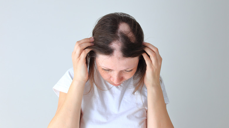 Woman displaying alopecia bald spots