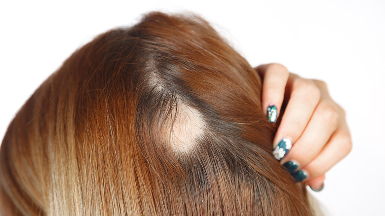 Woman displaying an alopecia bald spot