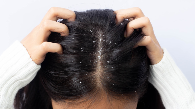 a girl with itchy head and dandruff