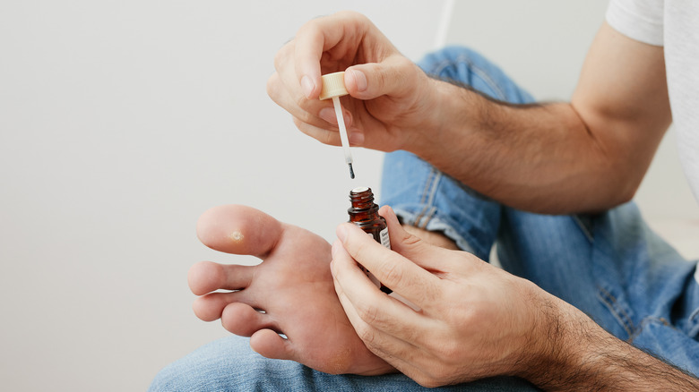 wart treatment
