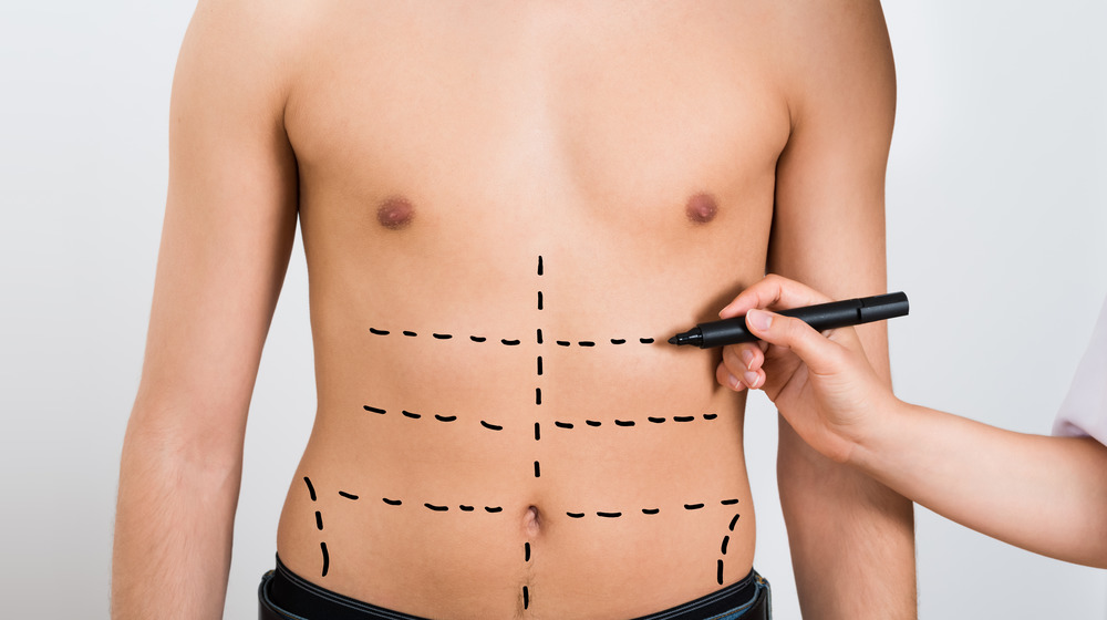 Plastic surgery drawing on a males abs 