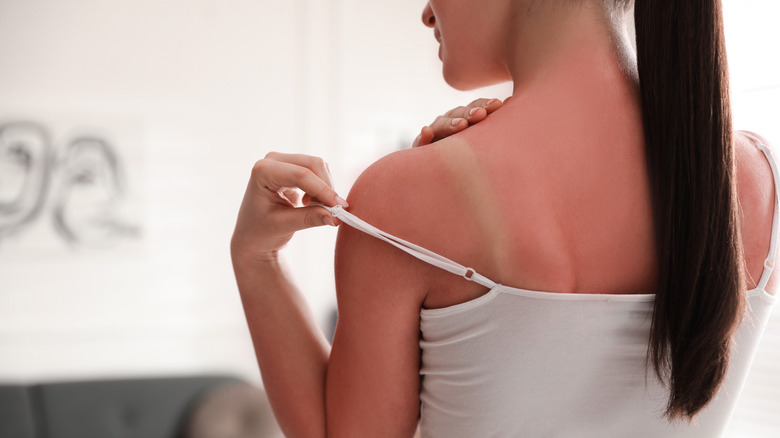 A woman with a sunburn