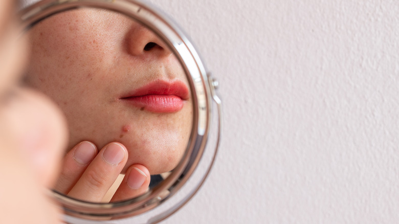 A woman looking at her breakout in a mirror