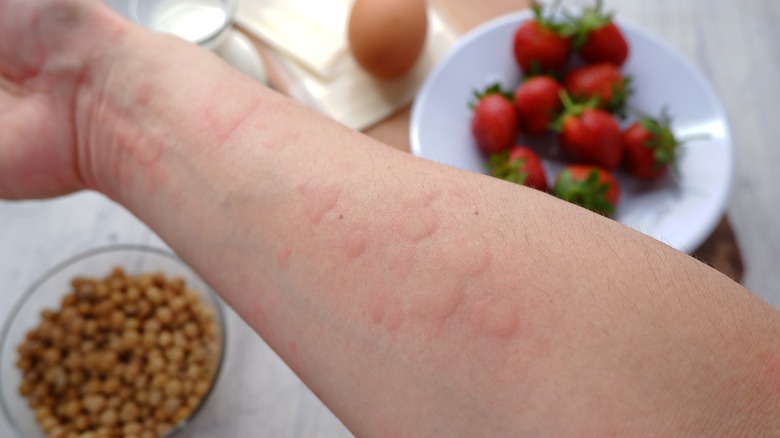 arm with allergic reaction to foods