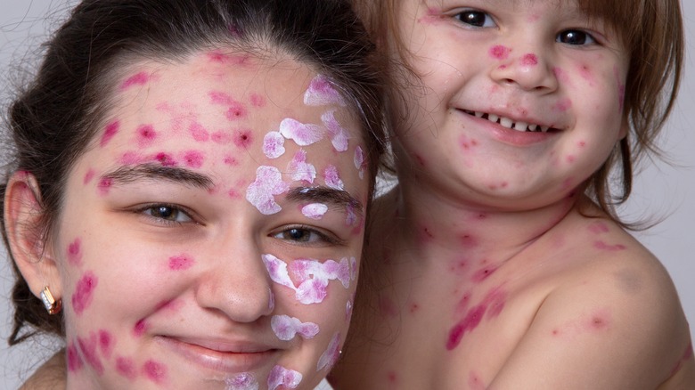 Teen and toddler with chickenpox 