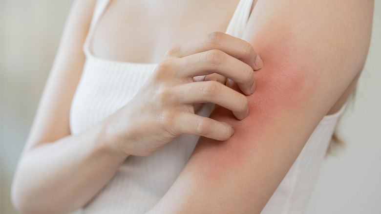 woman with allergies on arm