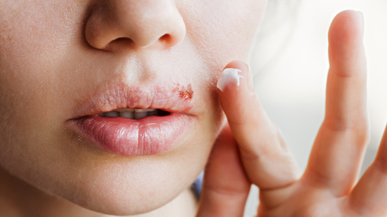 Woman applying ointment to cold sore