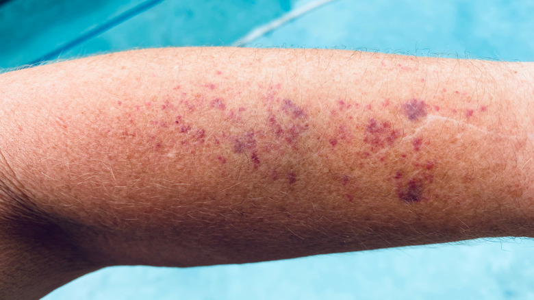 Arm covered in senile purpura bruises